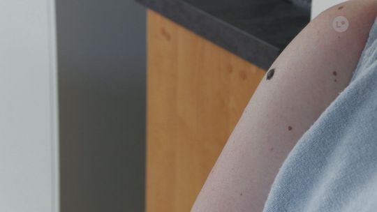 Coraz więcej chorych na czerniaka w Świętokrzyskiem