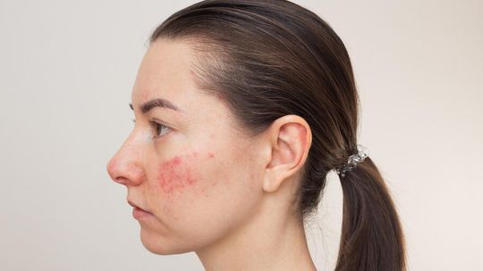 Stres i emocje – jak psychiczne obciążenia nasilają objawy trądziku różowatego?
